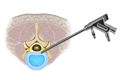 Mumbai, Health, Top Spine Surgeon In Mumbai At ZenSpine Dr. Dhake