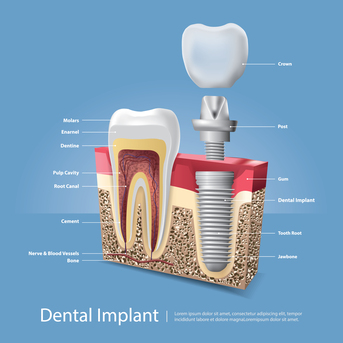 Mumbai, Health & Beauty Items, Dental Implants For A Confident, Healthy, And Long-Lasting Smile