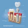 Dental Implants For A Confident, Healthy, And Long-Lasting Smile