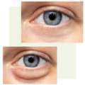 Expert Eyelid Surgery In Durham Restore A Youthful, Refreshed Look