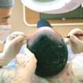 Best Hair Transplant Clinic In Mumbai For Natural Results