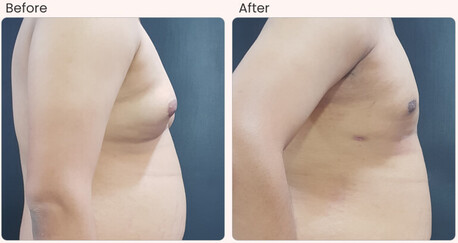 Mumbai, Health, Gynecomastia Surgery Cost In Delhi - Dr Rajat Gupta