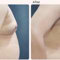 Gynecomastia Surgery Cost In Delhi - Dr Rajat Gupta