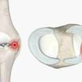 Choosing The Right ACL Surgeon In Singapore