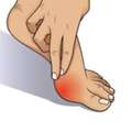 Effective Home Treatments For Bunion Pain Relief