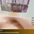 RF Microneedling In Raleigh For Skin Rejuvenation & Tightening