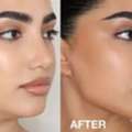 Jawline Contour Near Me | Expert Aesthetic Sculpting