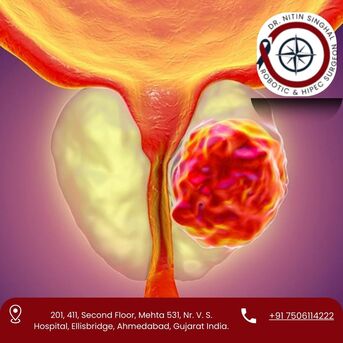 Ahmedabad, Health, Best Prostate Cancer Surgeon In Ahmedabad &ndash; Dr. Nitin Singhal
