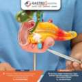 Gastro1 Hospital - Gallbladder Stone Treatment In Ahmedabad With Care And Comfort