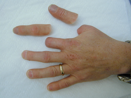 New York, Health, Finger Prosthetics | Custom, Natural-Looking Hand Solutions