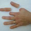 Finger Prosthetics | Custom, Natural-Looking Hand Solutions