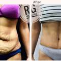 Tummy Tuck Surgery In Delhi -Dr Rajat Gupta