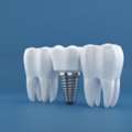 Long-Term Tooth Replacement With Dental Implant Kolkata