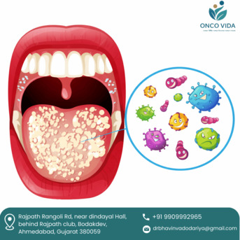 Ahmedabad, Health, Experienced Oral Cancer Surgeon In Ahmedabad | Dr Bhavin Vadodariya