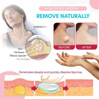 New York, Health & Beauty Items, USD 149,  New Treatment For Lipoma &ndash; Lipoma Wand