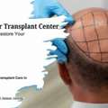 Hair Transplant In Varanasi With Advanced FUE Technology