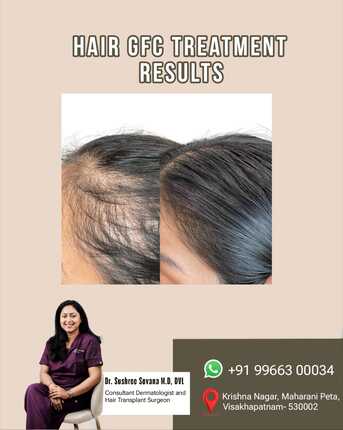 Visakhapatnam, Health, Hair GFC Treatment In Vizag - Derma One Clinic