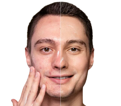 Noida, Health, Acne Scar Treatment In Noida | Dr. Radha Sharma