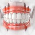 Advanced Implant Dentistry For A Confident Smile