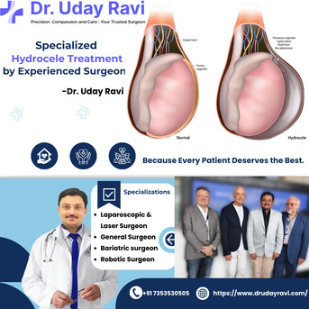 Bangalore, Health, Specialized Hydrocele Treatment By An Experienced Surgeon &ndash; Dr. Uday Ravi