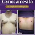 Best Gynecomastia Surgeon In Jaipur