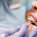 Affordable Dental Implants In Deccan Gymkhana | Trusted Dentists