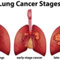 Lung Cancer Singapore: Symptoms, Diagnosis And Early Detection