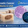 Pancreatic Cancer FFPE Blocks In USA For Research Use