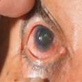 Cataract Surgery In Faridabad &ndash; Advanced Vision Restoration