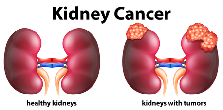 Mumbai, Health, Best Kidney Cancer Specialist In Delhi At Urethra Clinic