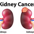 Best Kidney Cancer Specialist In Delhi At Urethra Clinic