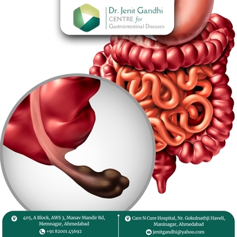 Ahmedabad, Health, Appendix Surgeon In Ahmedabad For Planned Surgery &ndash; Dr. Jenit Gandhi