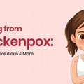 Chickenpox: Causes, Symptoms, Treatment & Prevention