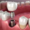 How To Choose The Right Dentist For Your Dental Implants?