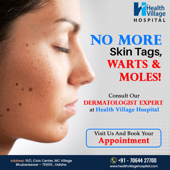 Mumbai, Health, No More Skin Tags, Warts, & Moles | Best Hospital In Bhubaneswar | Health Village Hospital