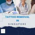 Tattoo Removal Singapore - Laser, Fast & Pain-Free Results