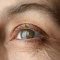 Clearer Vision With Safe Cataract Treatment