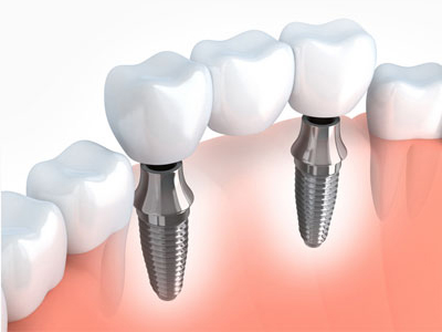 Washington DC, Dental, Why Patients Choose Dentures Implants For Full Mouth Restoration?