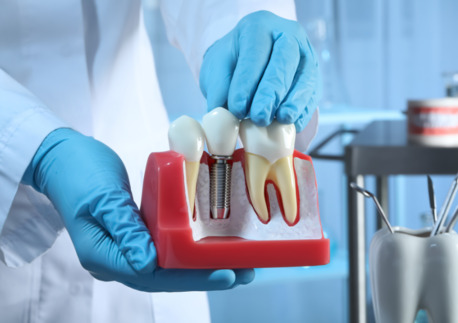 Washington DC, Dental, Why Patients Choose Dentures Implants For Full Mouth Restoration?