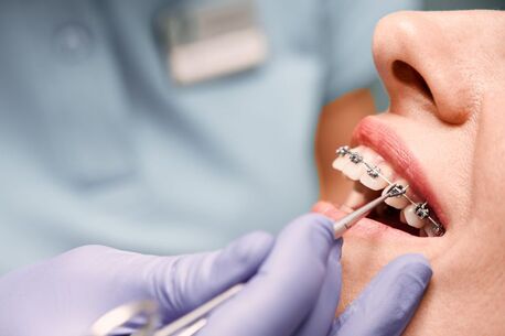Pune, Dental, Braces Cost In Pune | Price, Types & Treatment Options