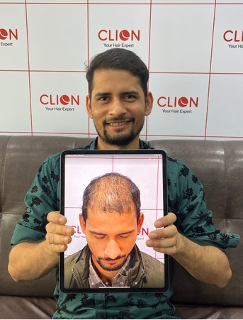 Ahmedabad, Health, Clion Care &ndash; Best Hair Transplant Clinic In Ahmedabad | Hair Loss Treatment