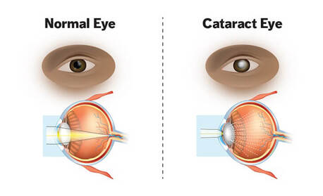 Mumbai, Health, Cataract Eye Surgery In Delhi - Dr Anisha Gupta