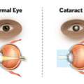 Cataract Eye Surgery In Delhi - Dr Anisha Gupta