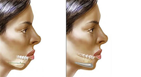 Mumbai, Health, Chin Augmentation Surgery Cost In Delhi - Dr Rajat Gupta