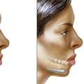 Chin Augmentation Surgery Cost In Delhi - Dr Rajat Gupta