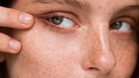 Dubai, Beautician, Advanced Acne Scar Treatment In Dubai &ndash; Restore Smooth, Clear Skin