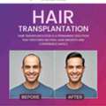 Is Hair Transplantation A Permanent Solution For Hair Loss?