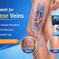 Treatment For Varicose Veins