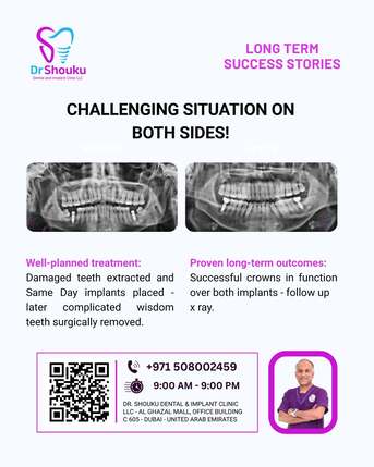 Dubai, Dental, Expert Dental Implant In Al Badaa By Dr Shouku Dental