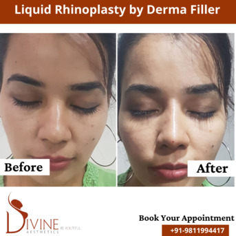 Mumbai, Health, Rhinoplasty Surgery In Delhi ~p~ Best Nose Surgeon